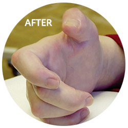 Dry Needling: after results on child's hand