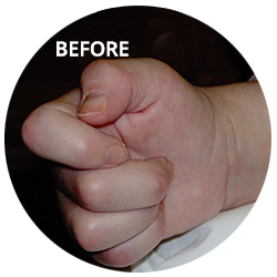 Dry Needling: before on child's hand